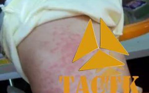 别慌 2岁前宝宝突然高烧，大部分都是因为它——可自愈的"幼儿急疹"